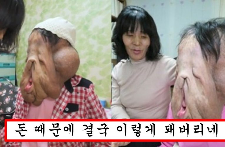 세상에 이런일이 33세 여인의 무너진 얼굴 심현희씨 충격 근황