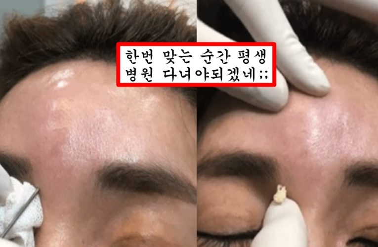 필러 맞은 사람들은 무조건 10년안에 해야한다는 녹이는 주사 맞아도 답 없는 필러 제거 영상